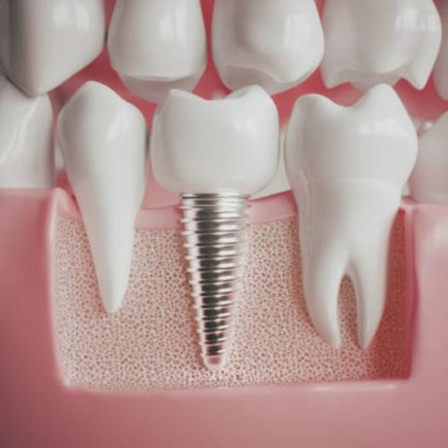 Implantes